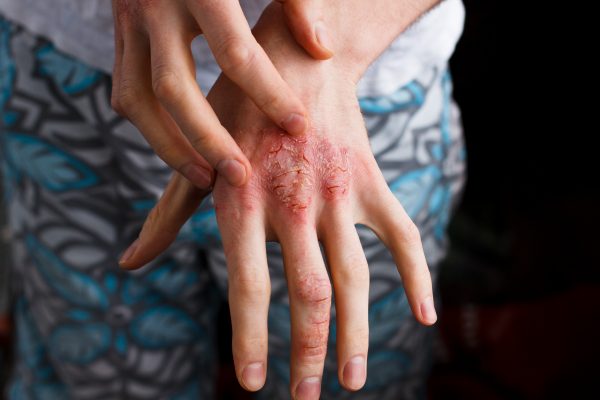 Atopic dermatitis