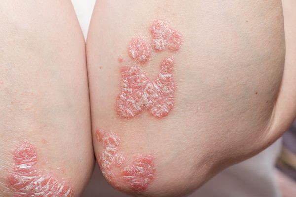 Psoriasis